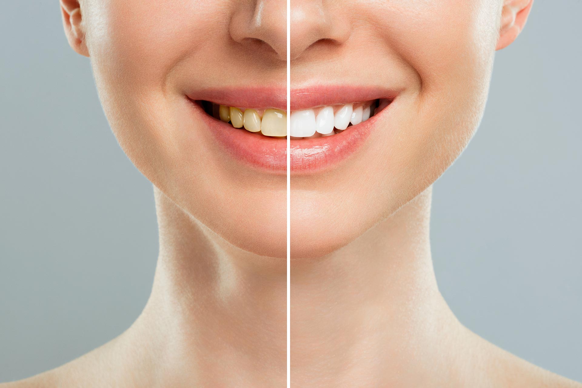 Zahnbleaching bei Zeinab Beauty