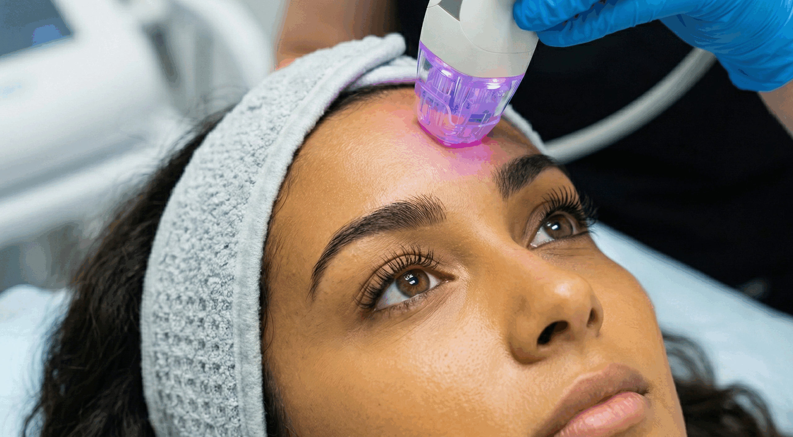 Radiofrequenz Needling bei Zeinab Beauty